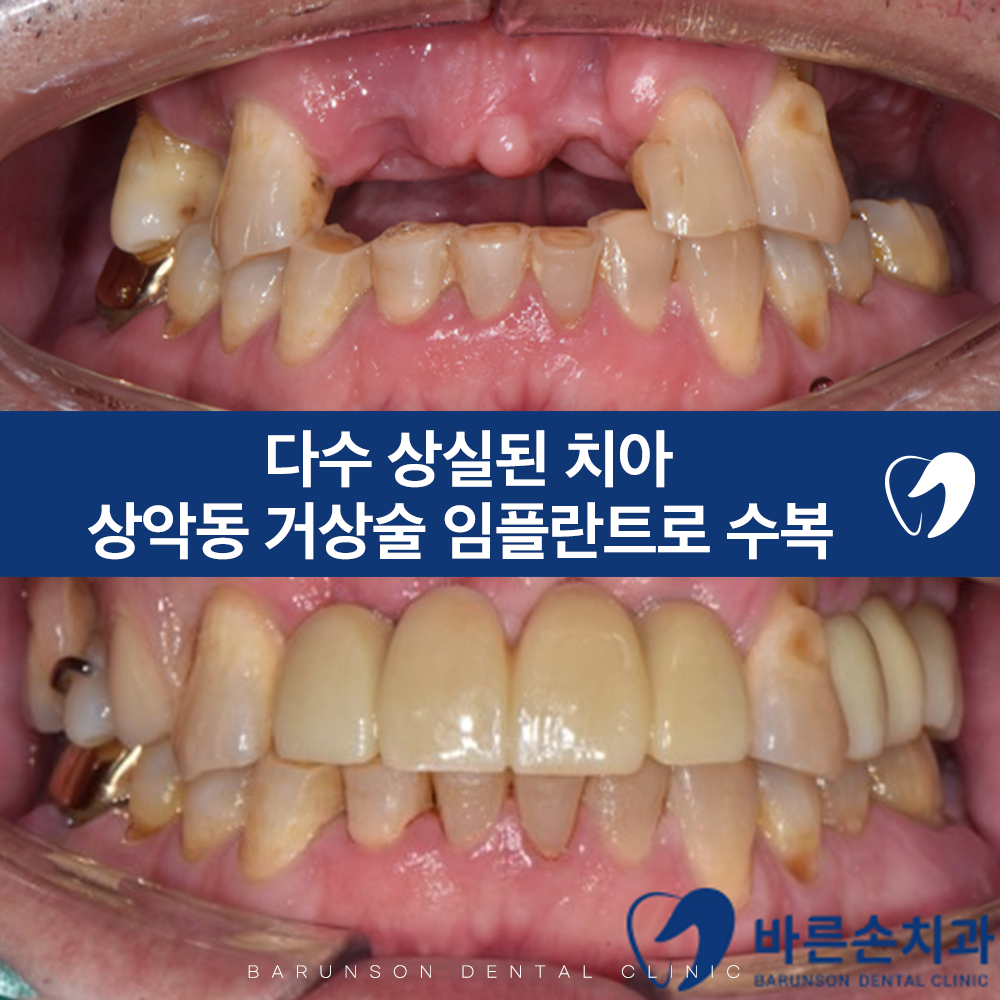 의정부임플란트