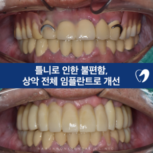 신곡동임플란트