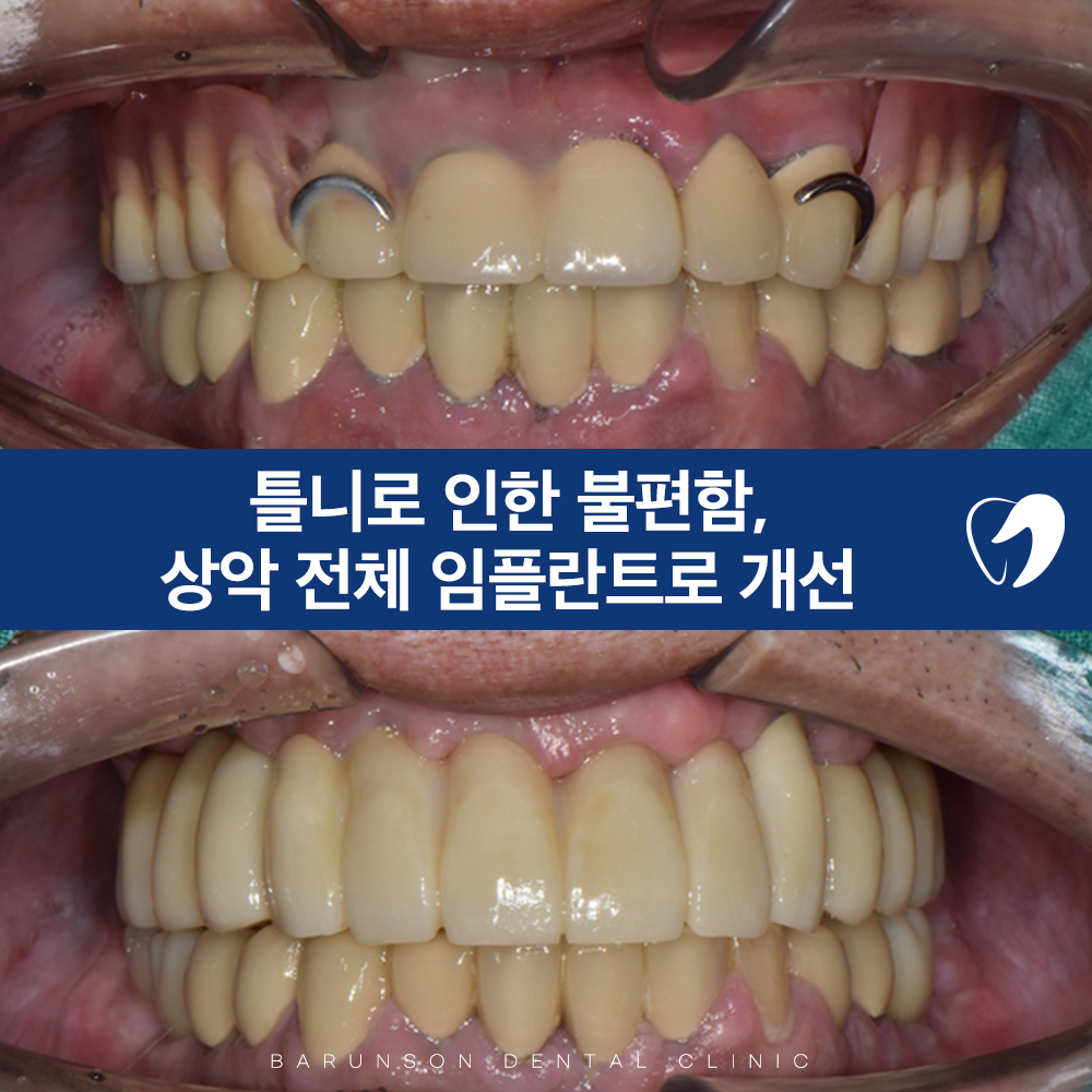 신곡동임플란트