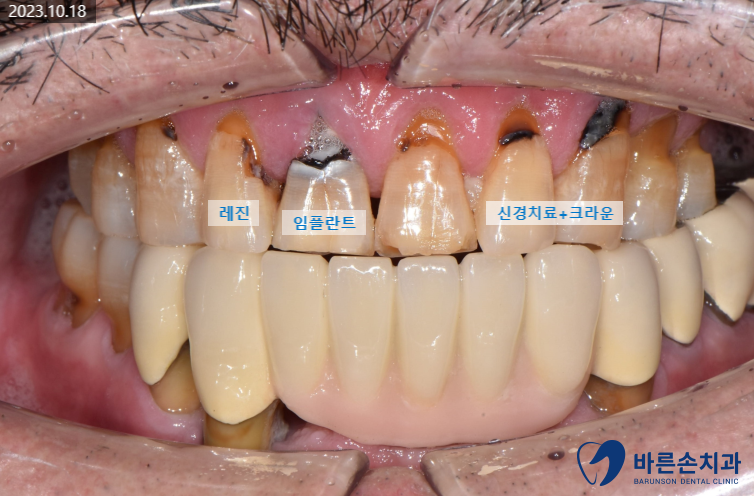 의정부임플란트