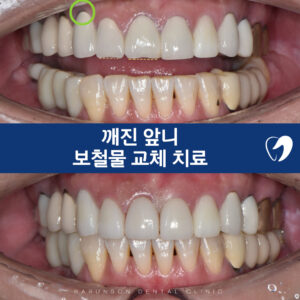대표이미지-깨진앞니-보철물
