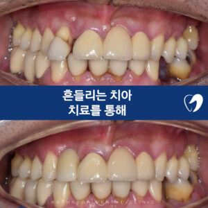 대표이미지-앞니임플란트