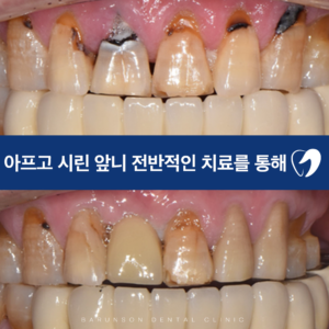 의정부임플란트
