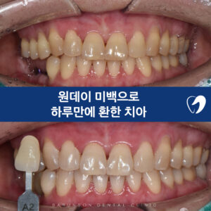 원데이미백-대표사진