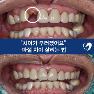 파절대표이미지