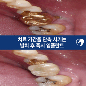 신곡동임플란트
