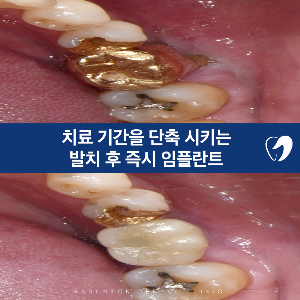 신곡동임플란트