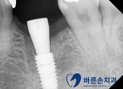 신곡동임플란트