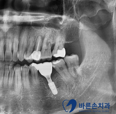 신곡동임플란트