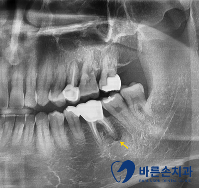 신곡동임플란트