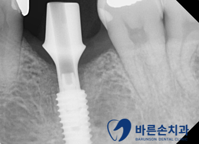 신곡동임플란트