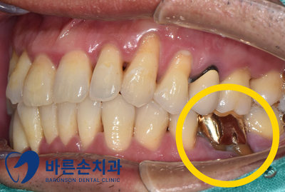 신곡동임플란트