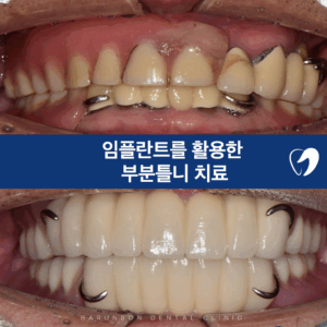의정부임플란트