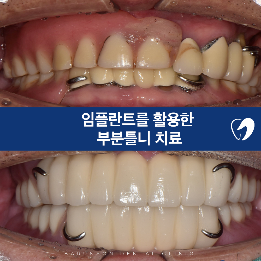 의정부임플란트