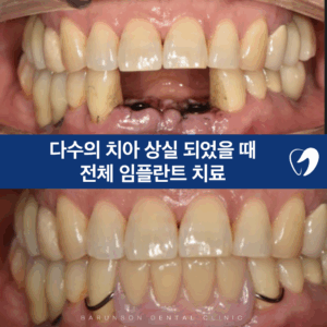 의정부임플란트