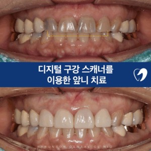 의정부임플란트
