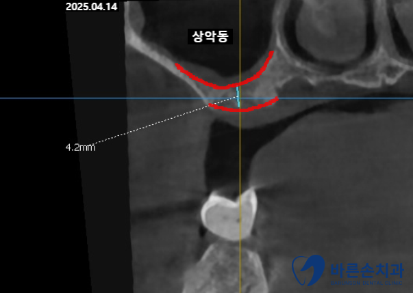 의정부임플란트