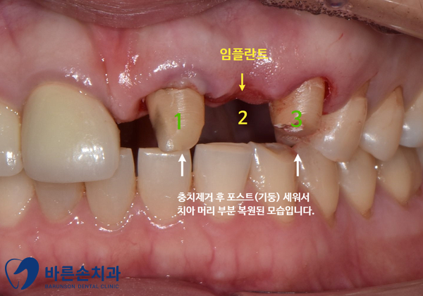 신곡동임플란트