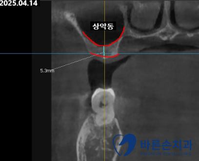 의정부임플란트