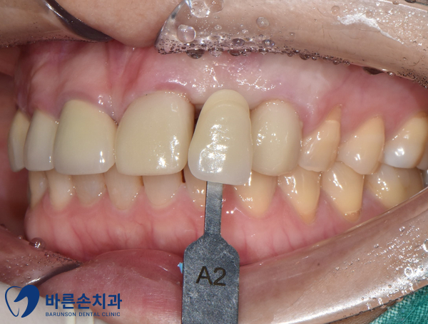 신곡동임플란트