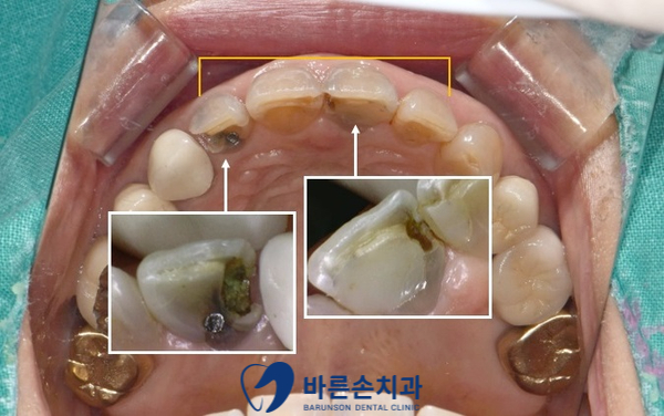 의정부임플란트