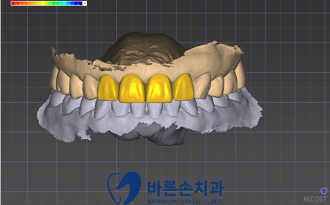 의정부임플란트