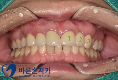 신곡동임플란트