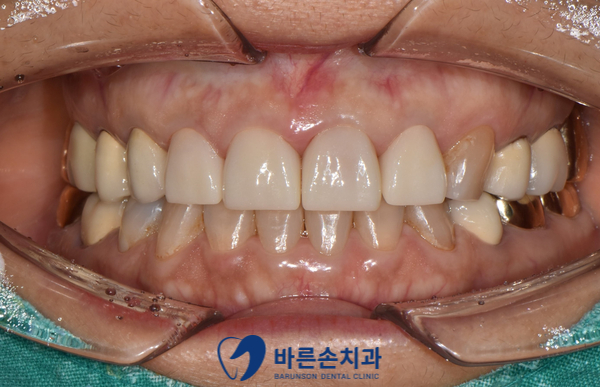 의정부임플란트