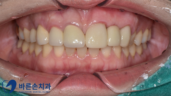 신곡동임플란트
