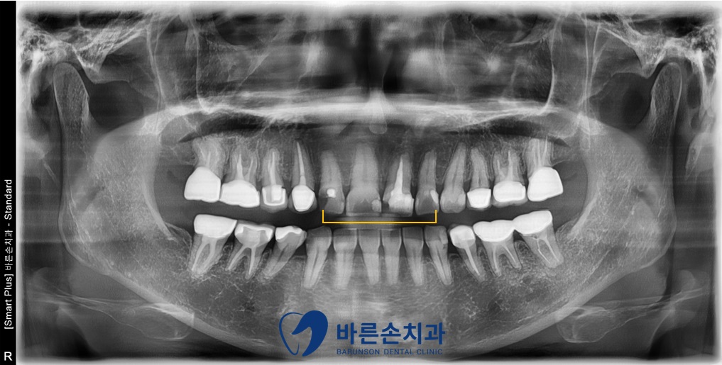 의정부임플란트