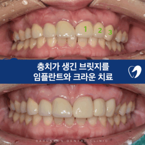 신곡동임플란트