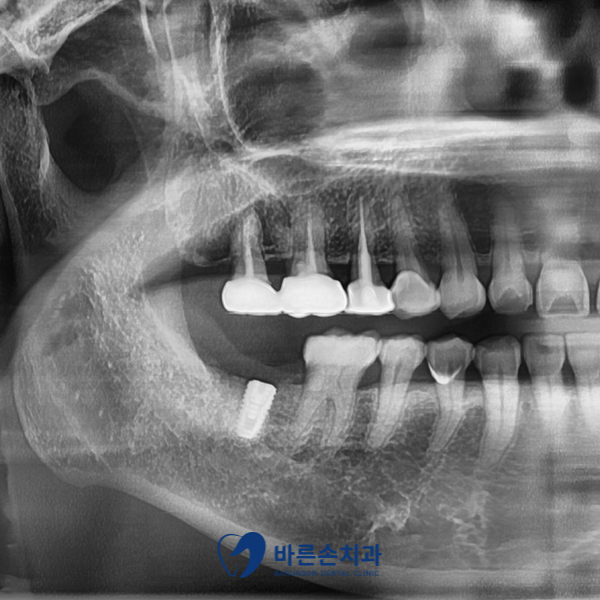 신곡동임플란트