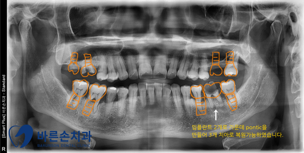 신곡동임플란트