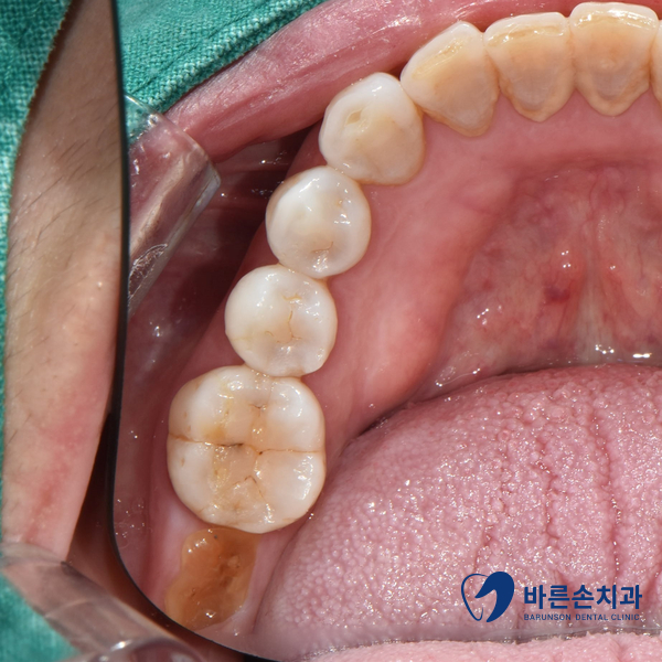 신곡동임플란트