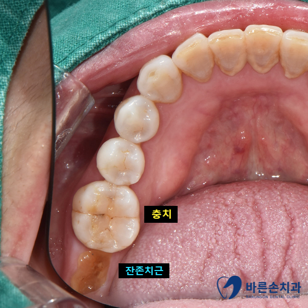 신곡동임플란트