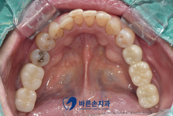 신곡동임플란트