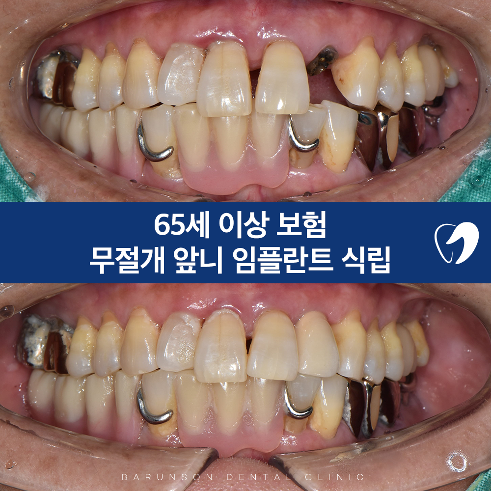 의정부임플란트