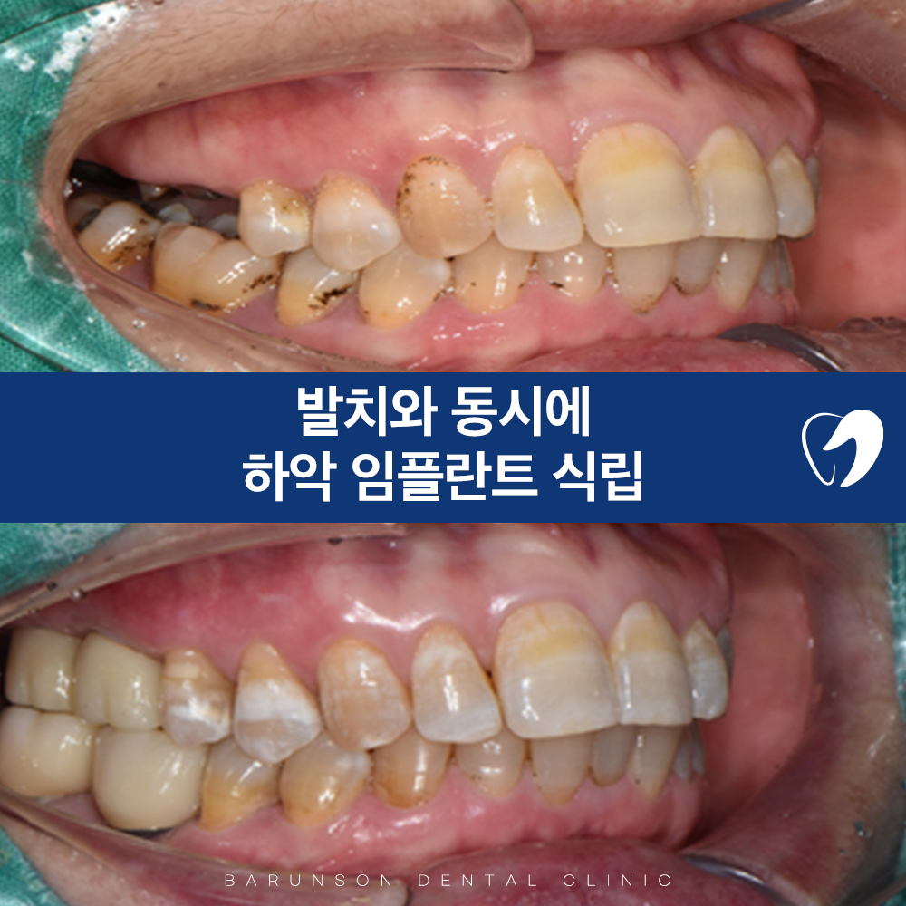 신곡동임플란트