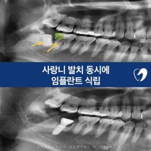 의정부임플란트
