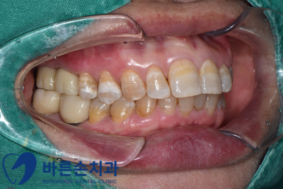 의정부임플란트