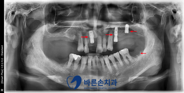 신곡동임플란트