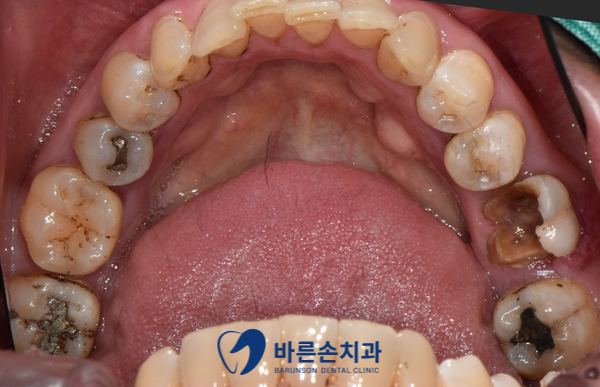 의정부임플란트