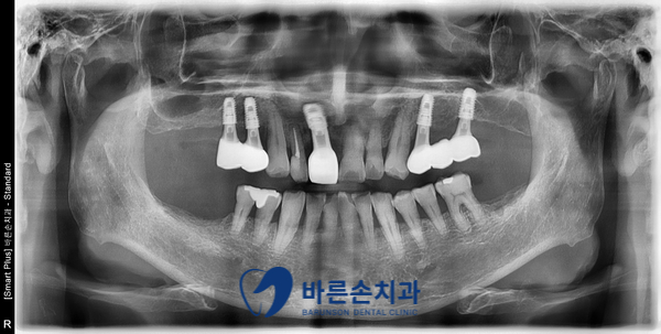 신곡동임플란트