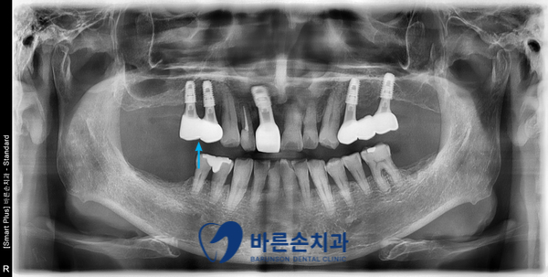 신곡동임플란트
