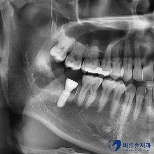 의정부임플란트