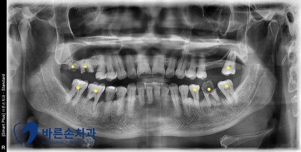 의정부임플란트
