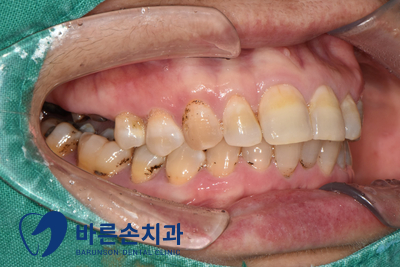 의정부임플란트
