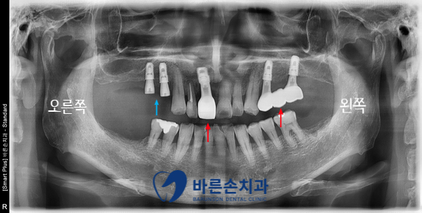 신곡동임플란트