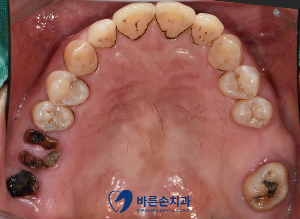 의정부임플란트