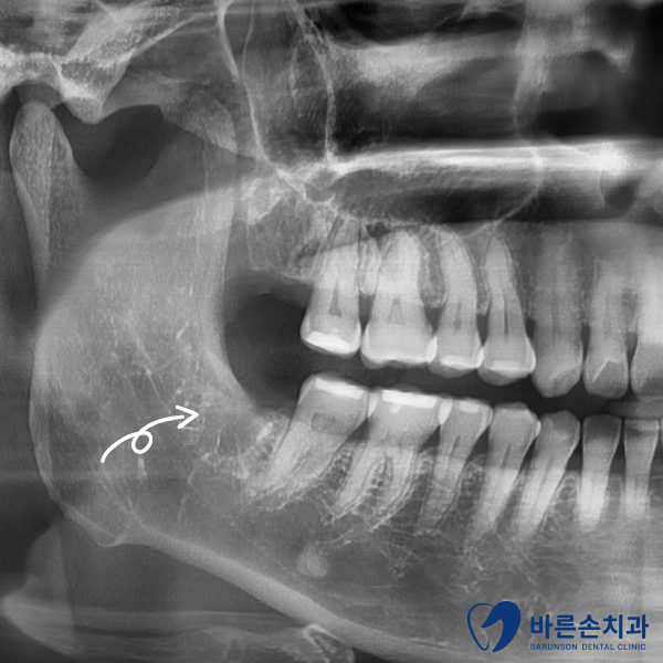 의정부임플란트